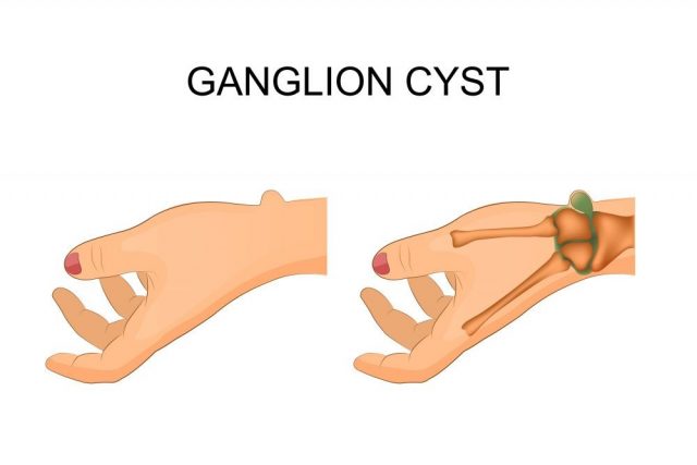 ector illustration of hygroma wrist joint, surgery