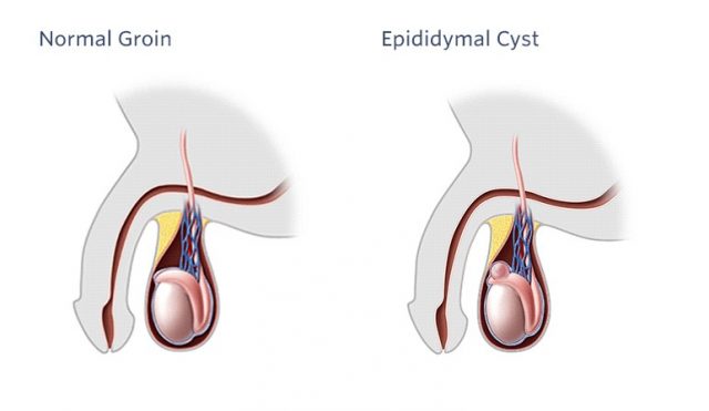Epididymal Cyst