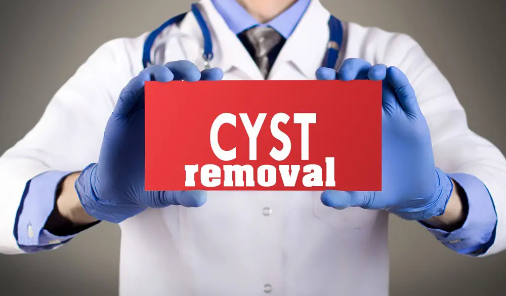 Cyst Removal