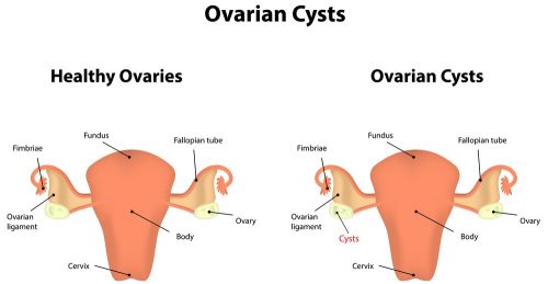 Do Women Have A Prostate: Cysts