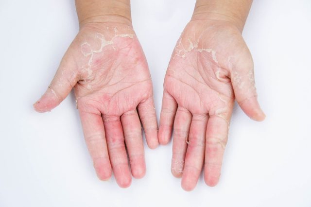 Dry hands, Contact dermatitis