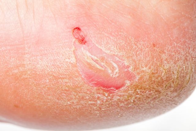 Close up photo of a person with dry skin on heel