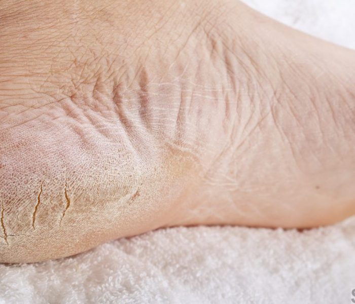 Dry skin on feet