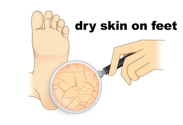 dry skin on feet