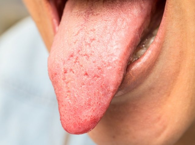 Yeast Infection causes dry skin on penis