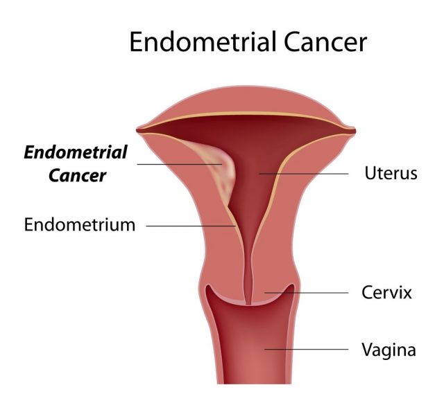 Endometrial cancer, most common type of uterine cancer