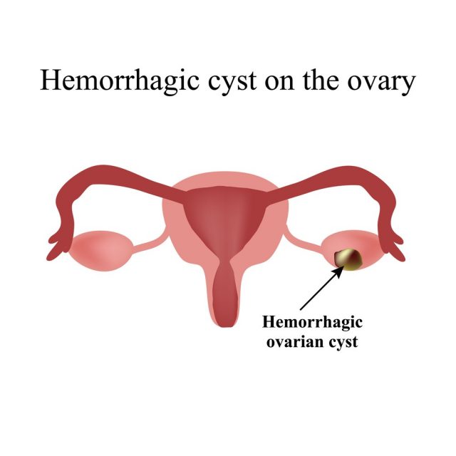 Hemorrhagic cyst on the ovary. Ovary. Infographic