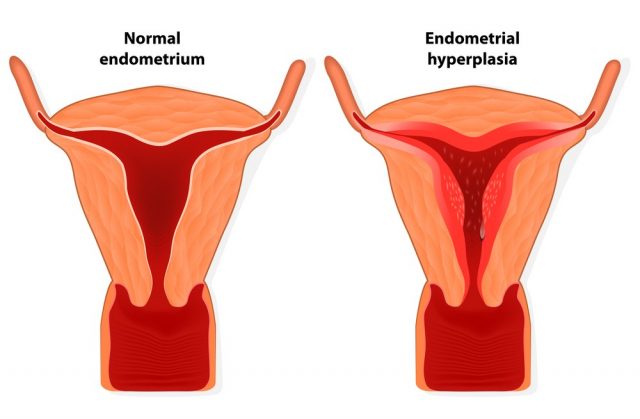 Endometriosis. Endometrial hyperplasia is an overgrowth of tissue in the endometrium uterus. The uterine lining becomes too thick which results in abnormal bleeding. Illustration