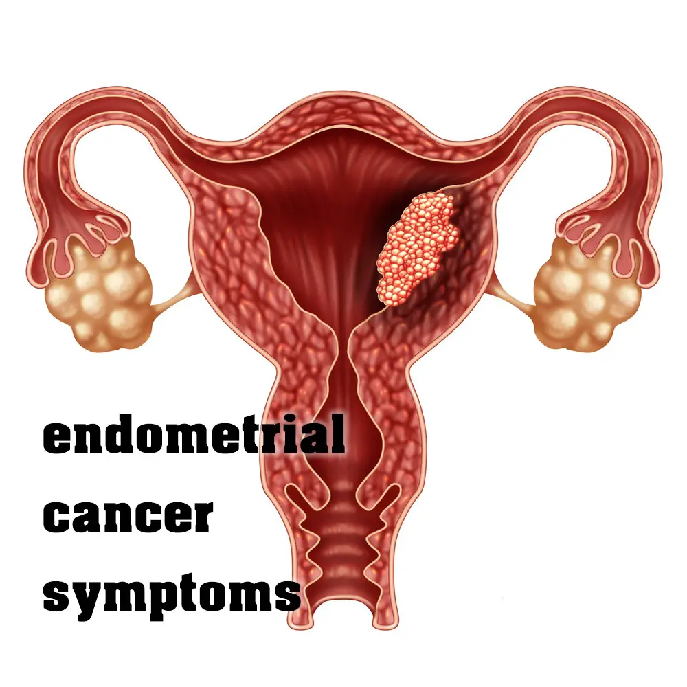 Endometrial Cancer Symptoms