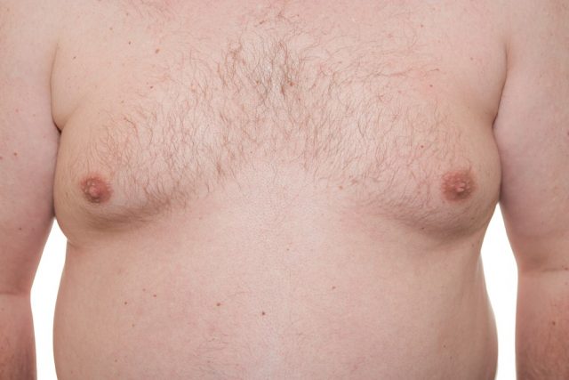 Male thorax showing early stage Gynecomastia or man boobs also a symptom of obesity