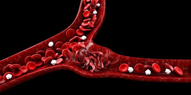 Sickle cell anemia, 3D illustration showing blood vessel with normal and deformed crescent