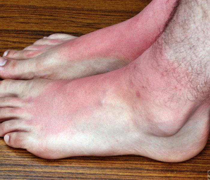 Foot rash