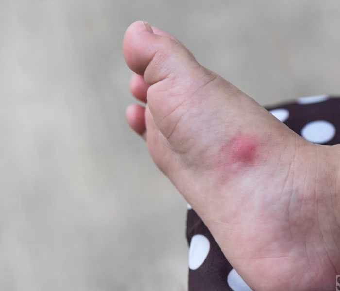 Foot rash