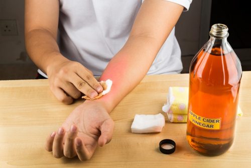 Foot rash: Apple cider vinegar