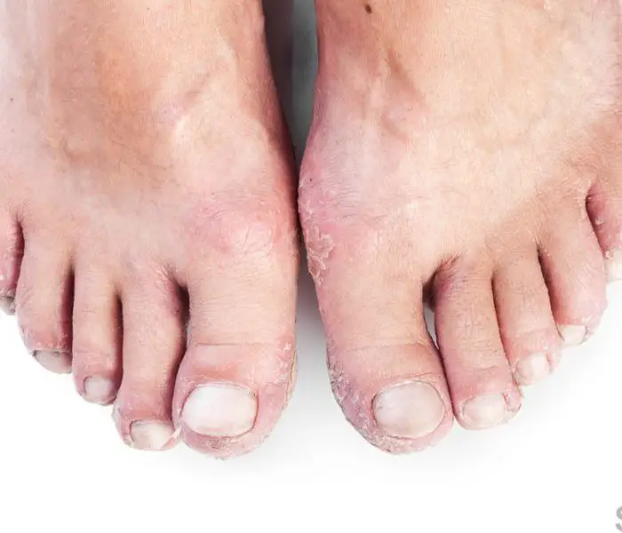 Foot Rash Causes Symptoms Home Remedies And Treatment Pictures