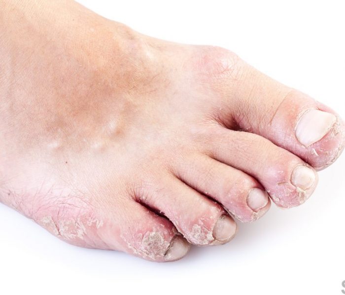 Foot rash