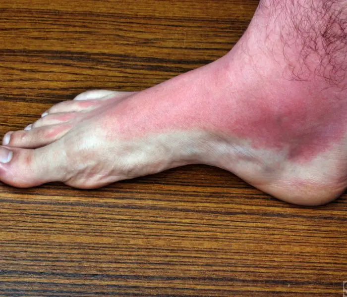 Foot rash