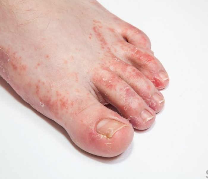 Foot rash causes, symptoms, home remedies & treatment