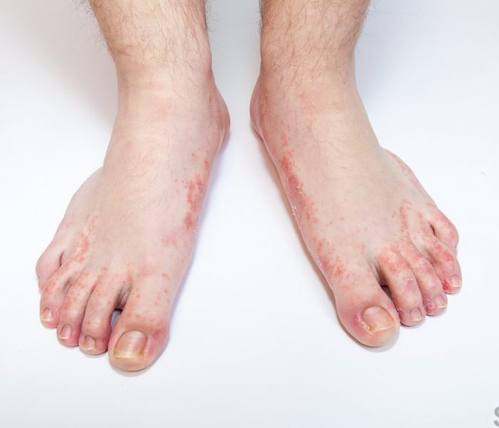 Foot rash