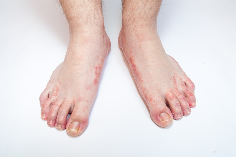 Foot rash causes, symptoms, home remedies & treatment, pictures
