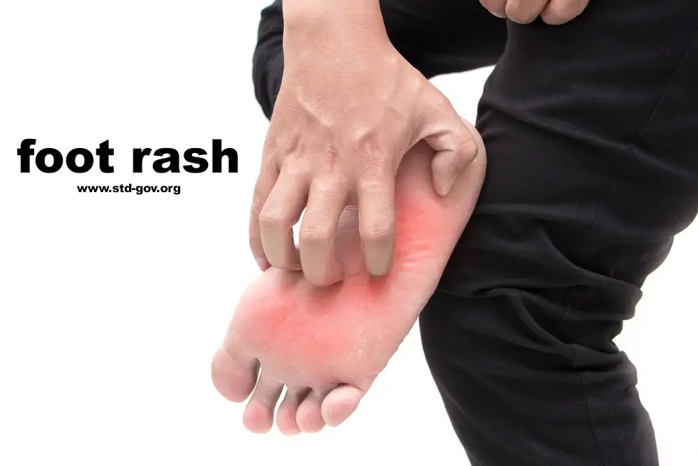 Foot rash