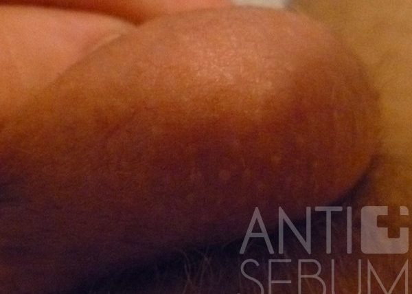 Pimple on penis: fordyce spots