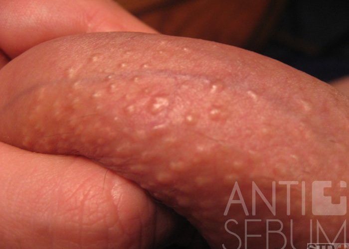 White Circles On Penis 35