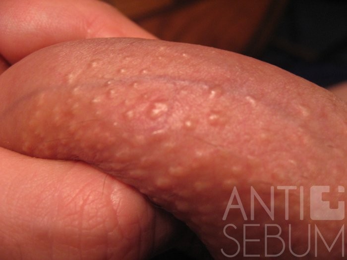 What causes pimples on penis? 
