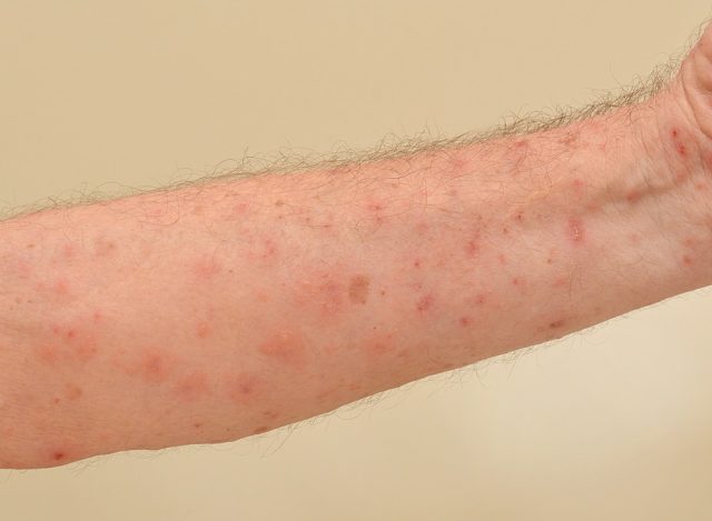 Close up of an elderly man's inner forearm arm severely infested with Scapies mites (Sarcoptes scabiei)