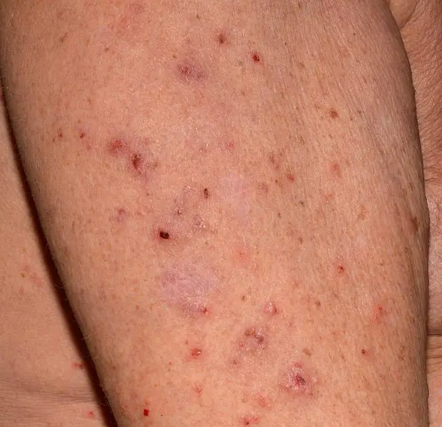 Close up of an elderly man's upper arm infested with Scapies mites (Sarcoptes scabiei)