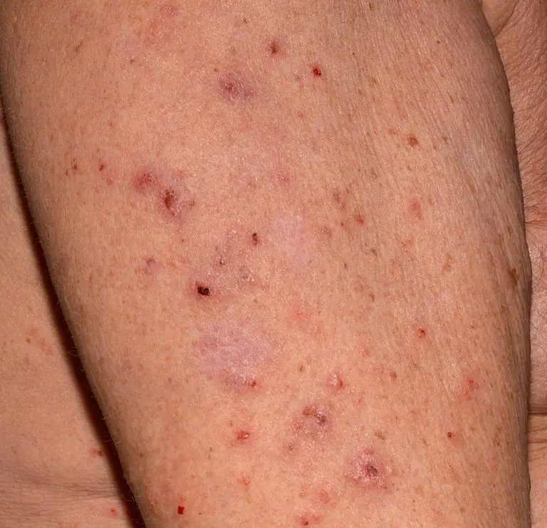 How Do You Get Scabies causes, symptoms, treatment, pictures