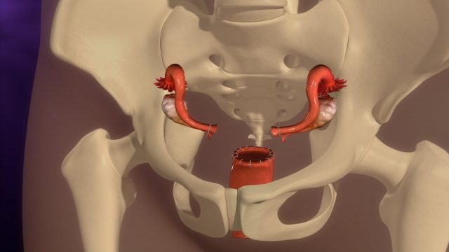 Hysterectomy 3d illustration