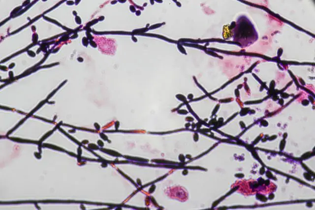 Yeast cells and Pseudohyphae yeast cells (Fungus)