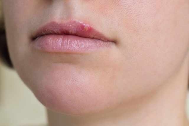 Female lips suffering from herpes