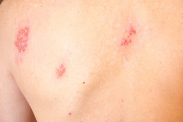 Shingles on men herpes zoster