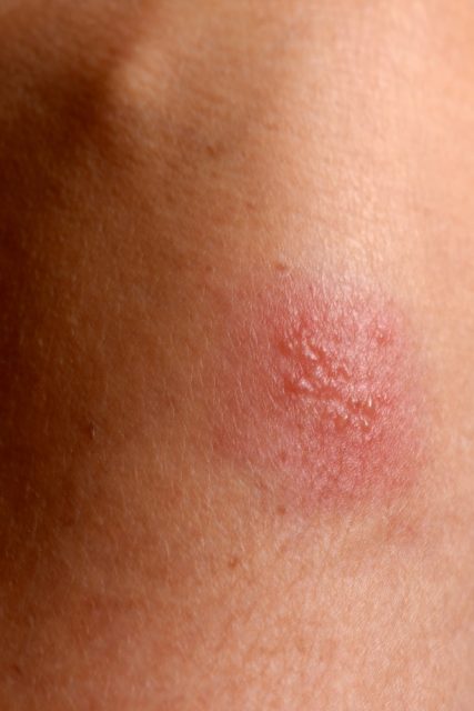 Herpes simplex on arm