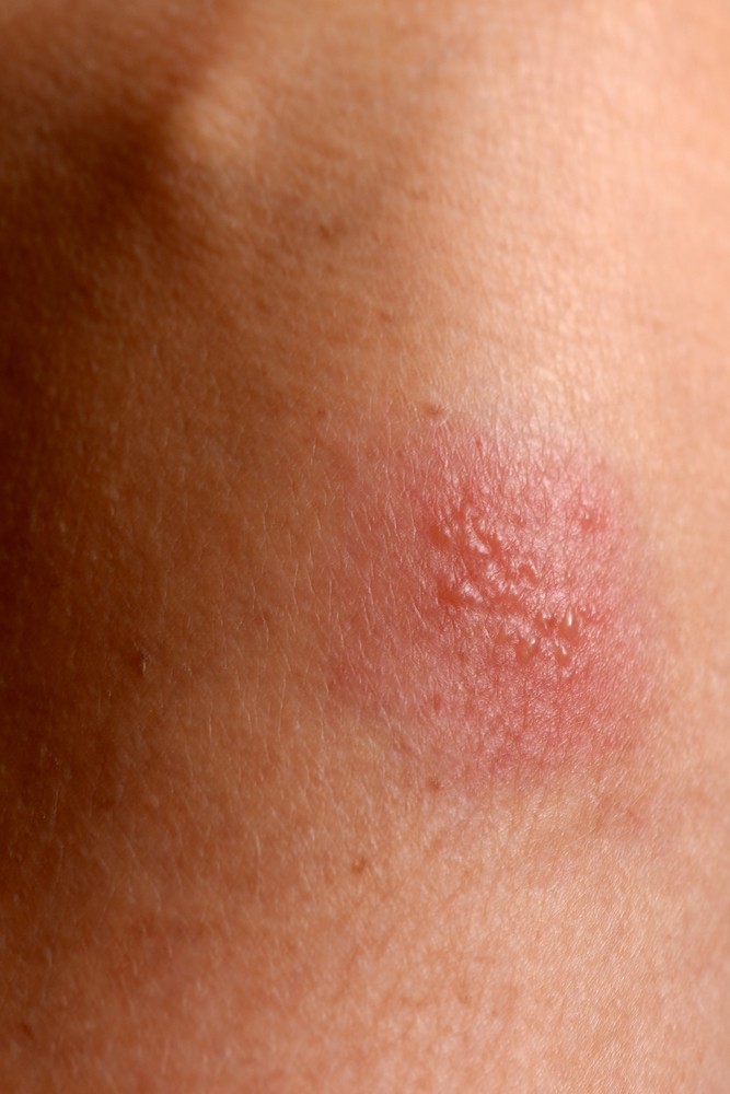 Living with Herpes causes, symptoms, how to deal with herpes?