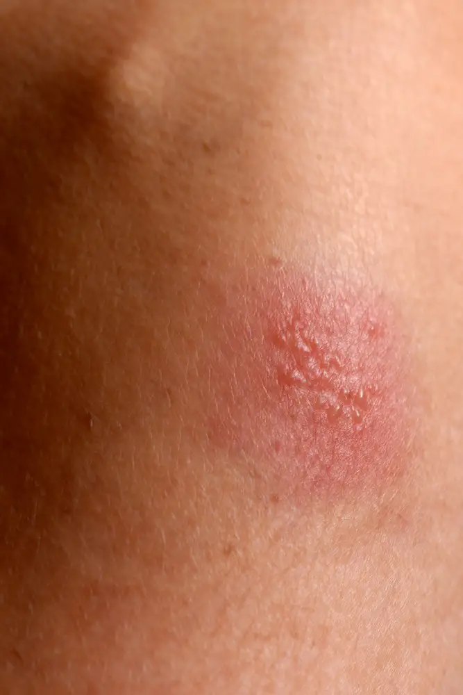 Living with Herpes causes, symptoms, how to deal with herpes?