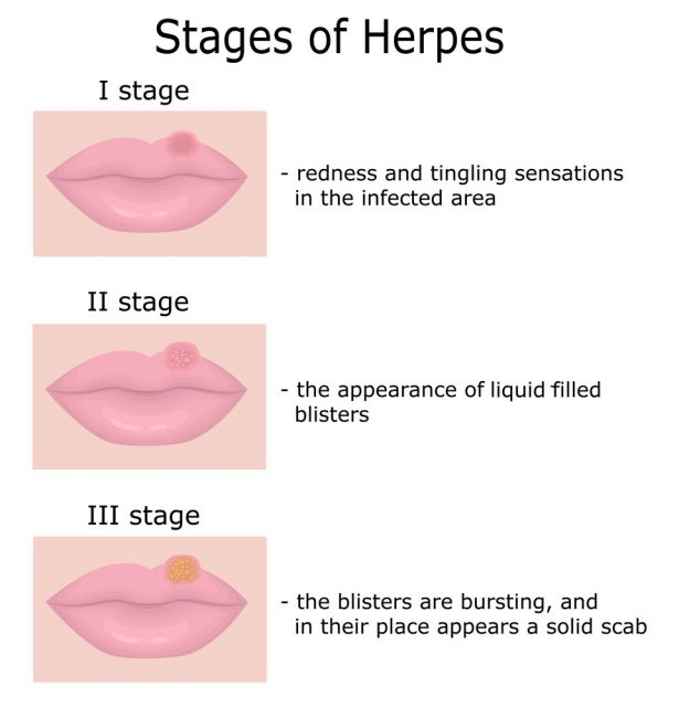 Stages of Herpes on the lips with a description of disease