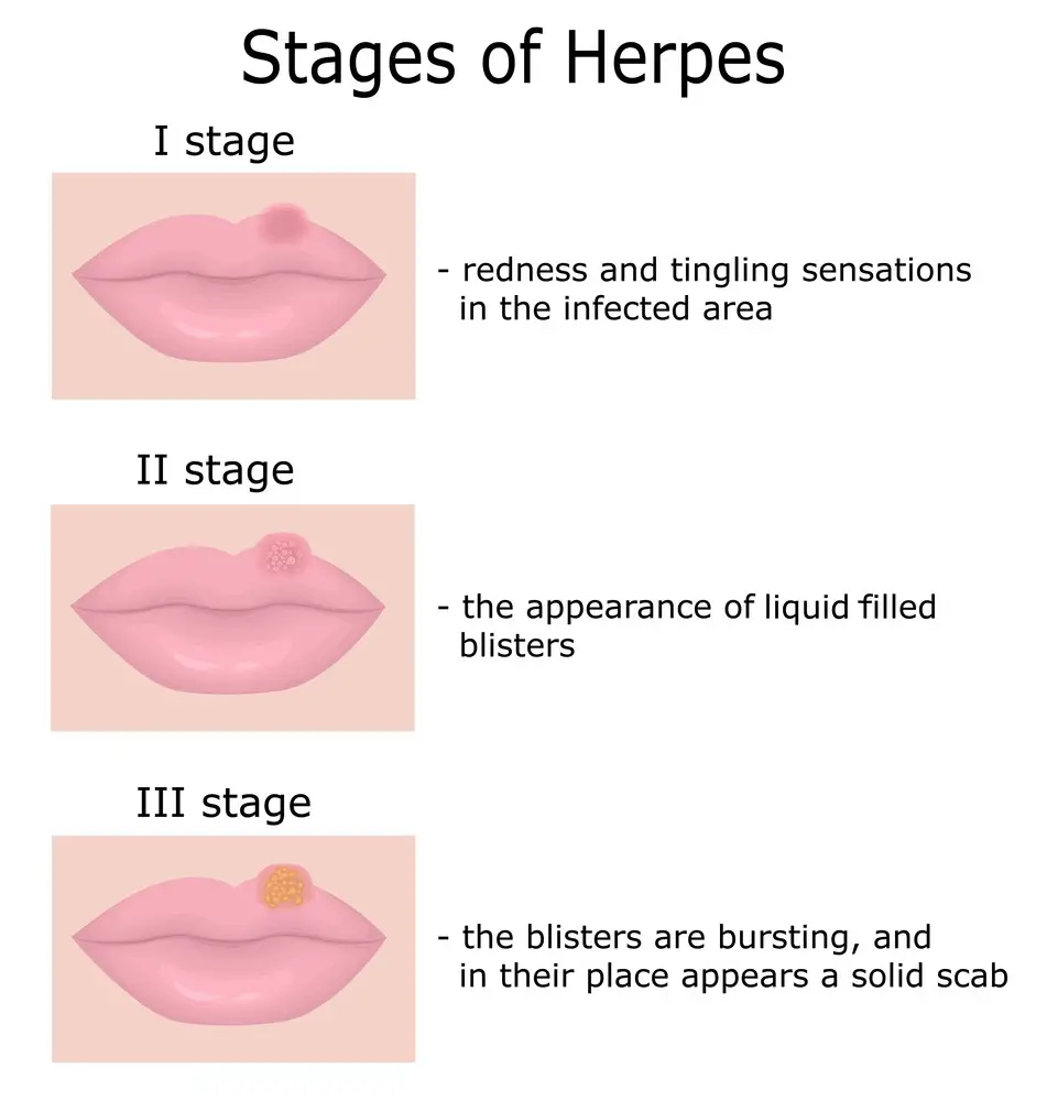 Collection 100+ Images photos of herpes on the lips Stunning