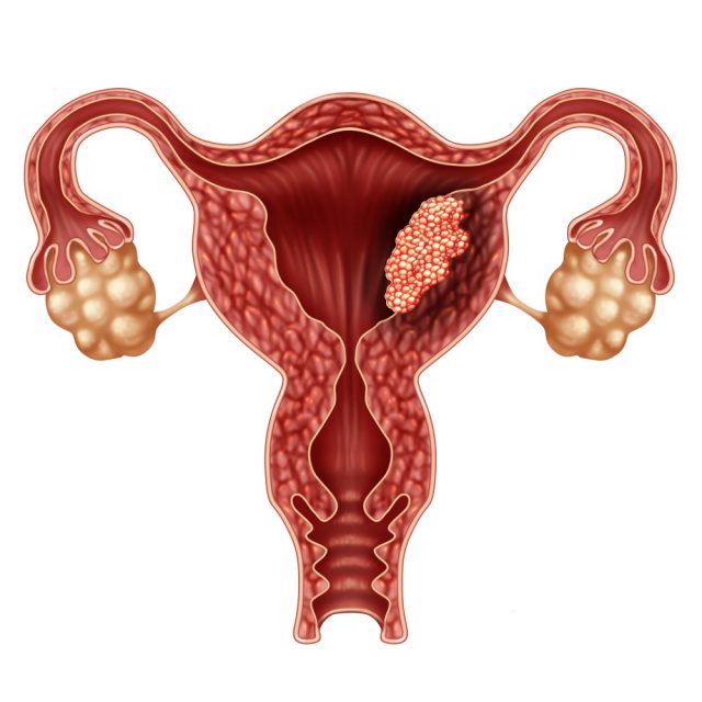 Endometrial cancer