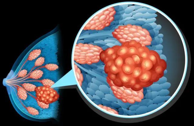 Breast cancer diagram close up illustration