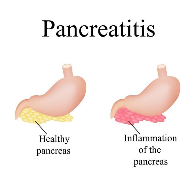 Inflammation of the pancreas. Pancreatitis