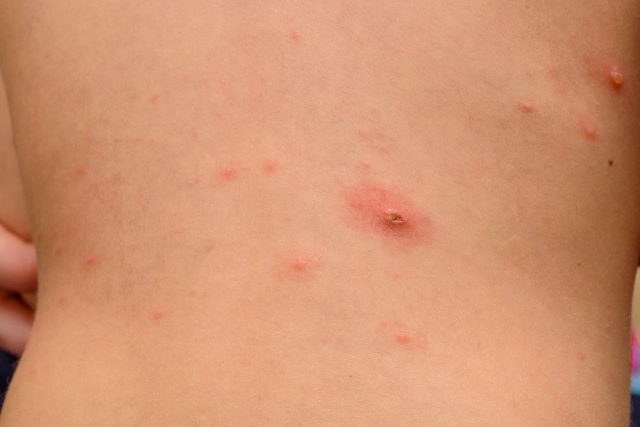 Varicella zoster virus or Chickenpox bubble rash on child
