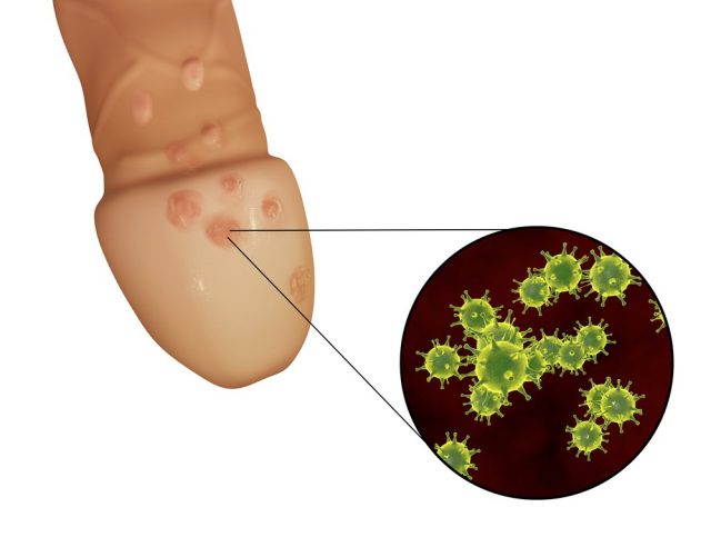 Genital herpes lesions and close-up view of herpes simplex viruses attaching to human cells, 3D illustration