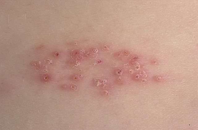 Mild herpes photo 2