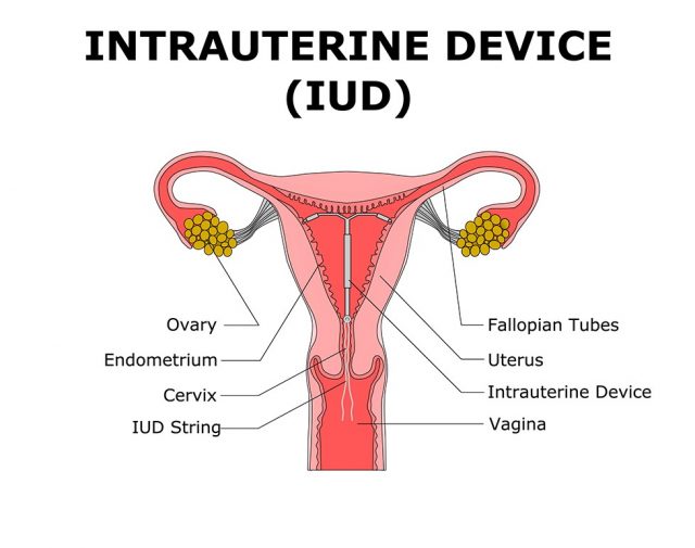 Copper IUD:INTRAUTERINE DEVICE