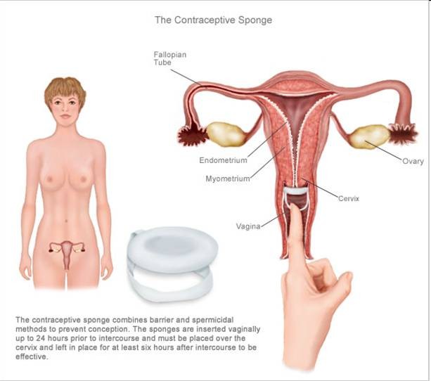Contraceptive sponge