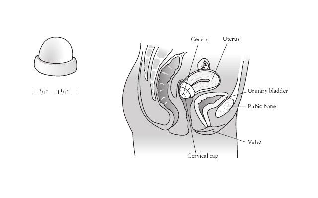 Cervical cap