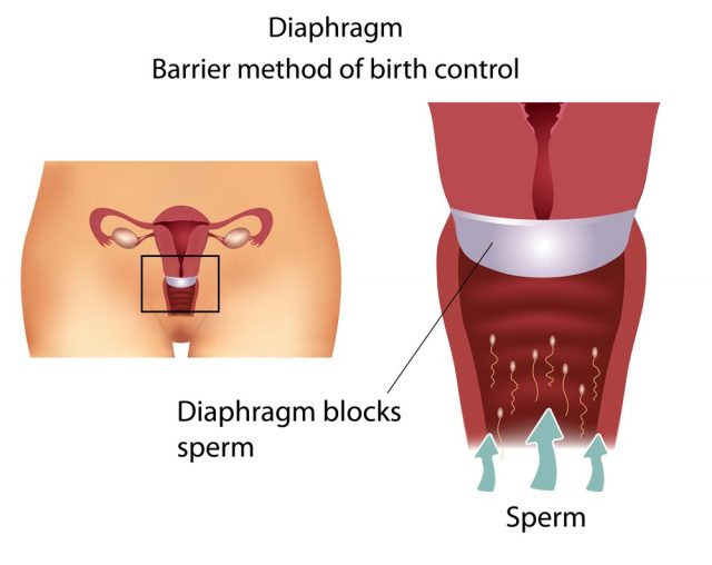 Barrier contraceptive method- Diaphragm. Detailed female reproductive anatomy